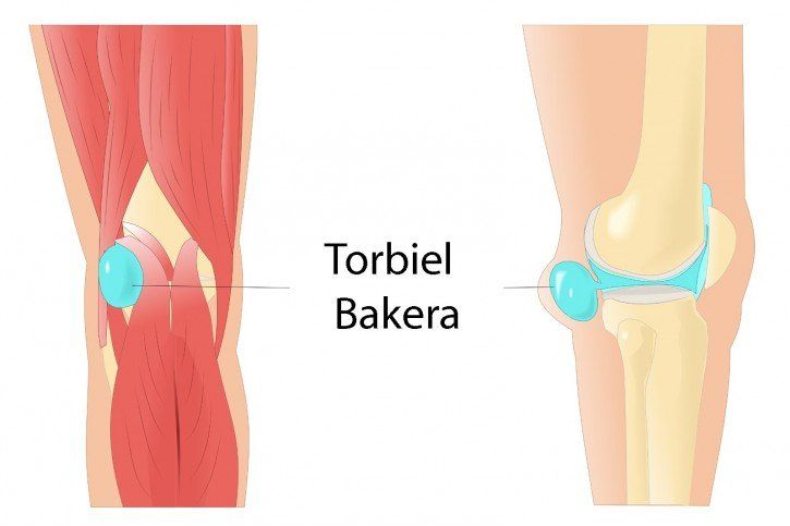 Torbiel Bakera - cysta Bakera