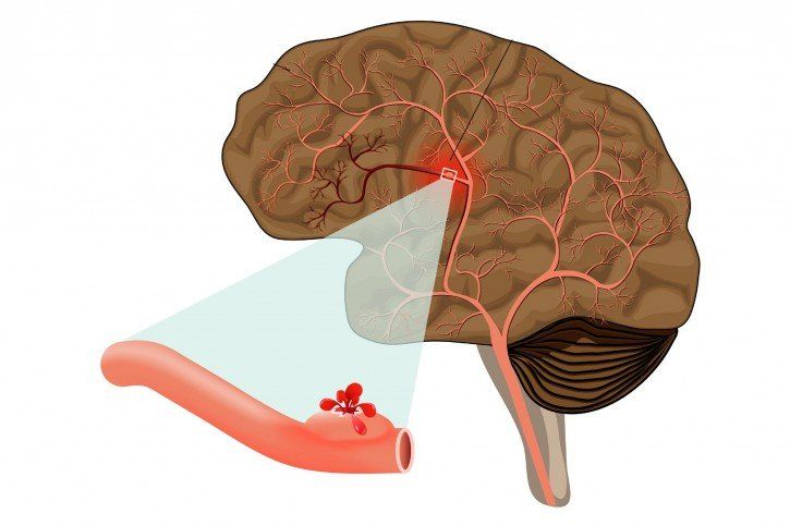 Udar krwotoczny mózgu