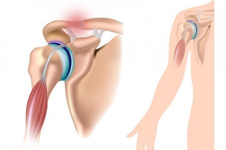 Uszkodzenie stawu barkowo - obojczykowego