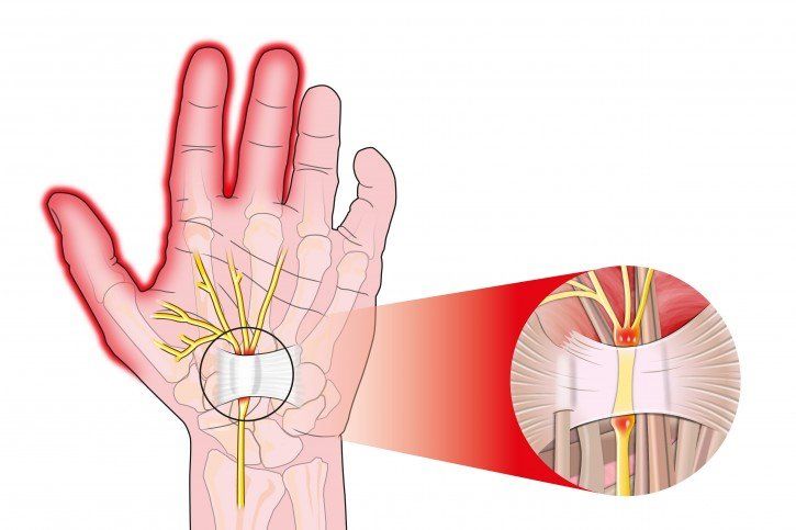 Zespół cieśni nadgarstka