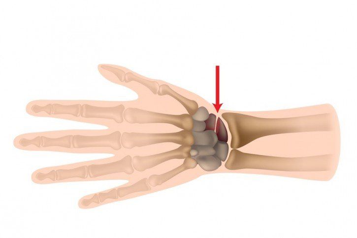Złamanie kości łódeczkowatej.